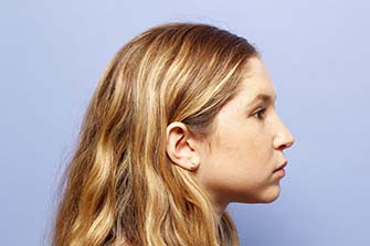After Rhinoplasty NYC