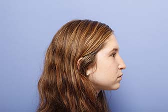 Before Rhinoplasty NYC