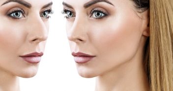 a woman's before and after rhinoplasty
