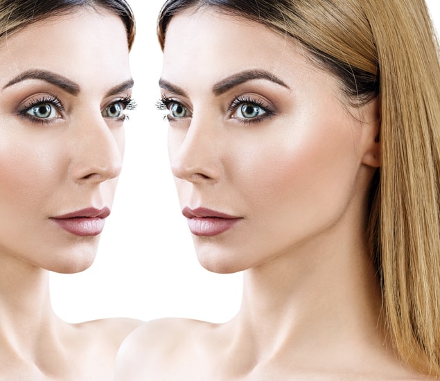 a woman's before and after rhinoplasty