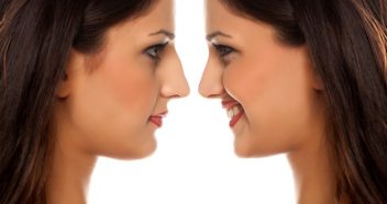 Female Nose Job 2.26.18