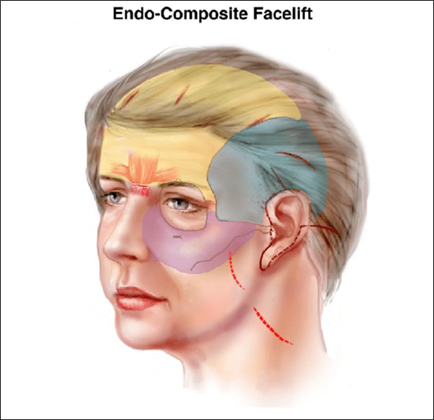 Endo-Composite Facelift