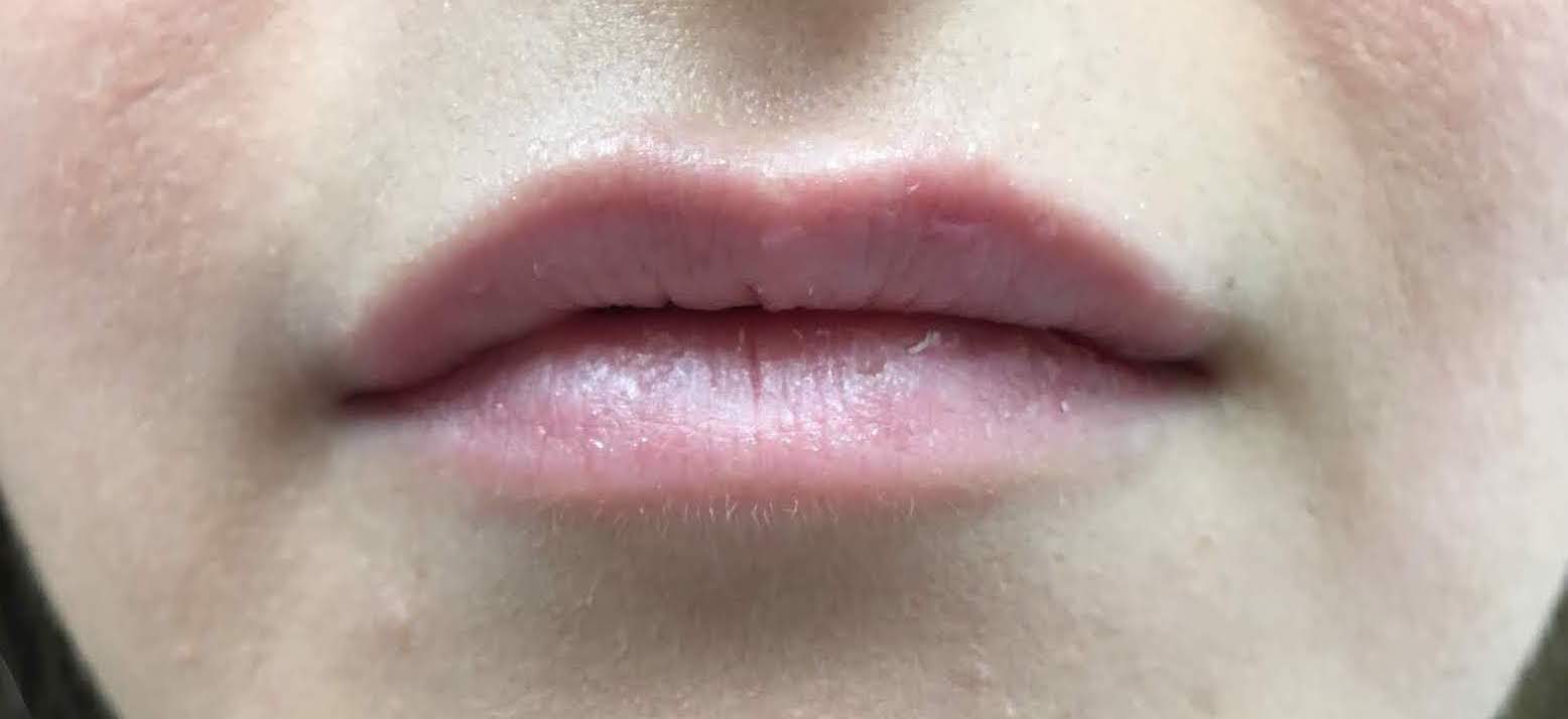 Lip Augmentation Before and After NYC