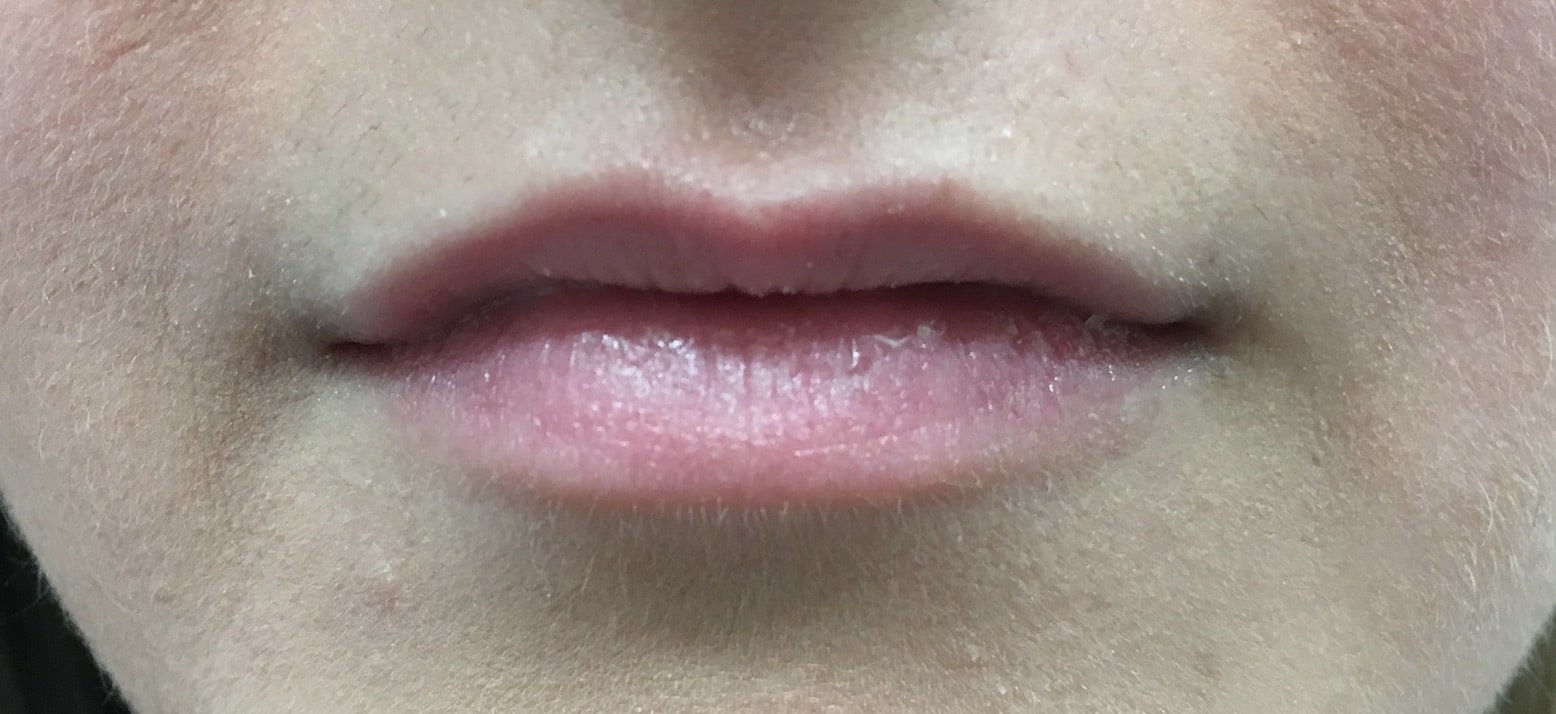 Lip Augmentation Before and After NYC