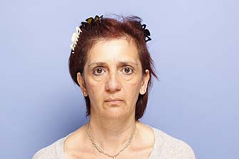 Close up headshot of adult woman before facial implant