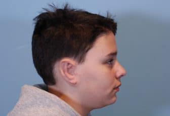 After Microtia New York