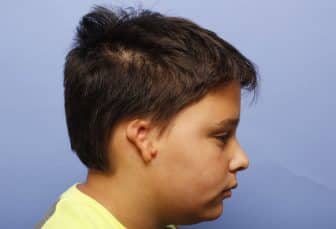 Before Microtia New York
