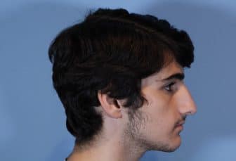 LA-pre-op-Male-Rhinoplasty-336x229_b3