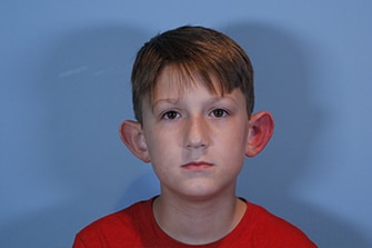 Close up picture of boy before otoplasty procedure