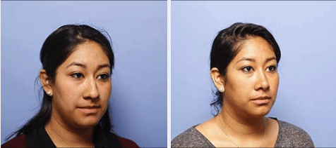 Before & After Ethnic Rhinoplasty New York