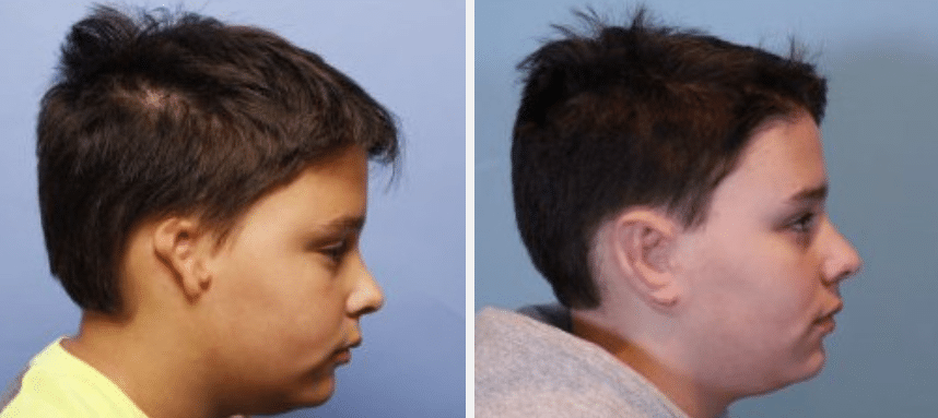 Microtia Surgery NYC