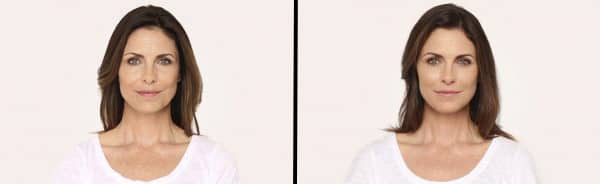 Before & After Juvederm New York