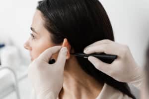 Otoplasty markup for surgical reshaping of the pinna, or outer ear for correcting an irregularity and improving appearance. Surgeon doctor marking girl ear before otoplasty cosmetic surgery.