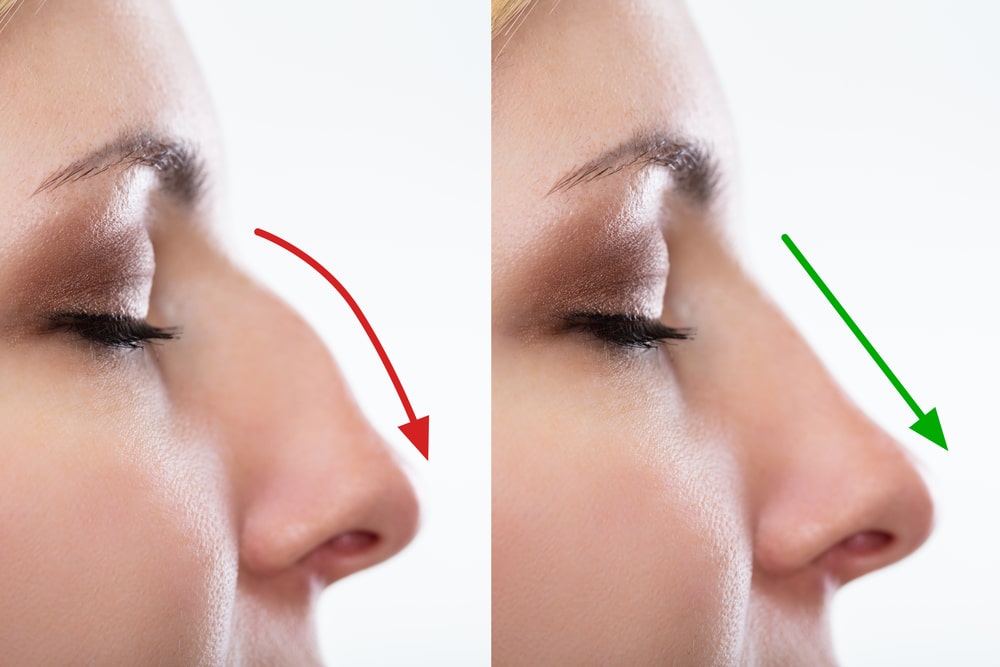 Woman's Nose Before And After Plastic Surgery