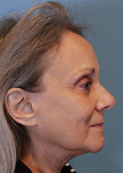 Facelift Patient – Case 2