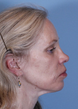 Facelift Patient – Case 4