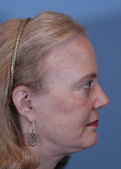 Facelift Patient – Case 5