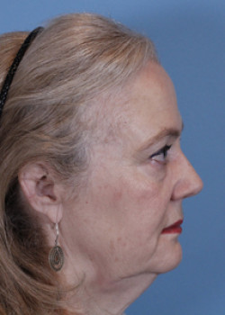 Facelift Patient – Case 5