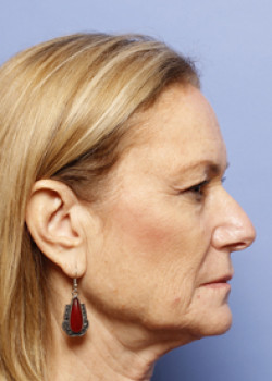 Facelift Patient – Case 6