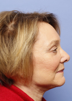 Facelift Patient – Case 8