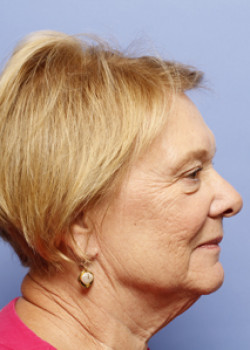 Facelift Patient – Case 8