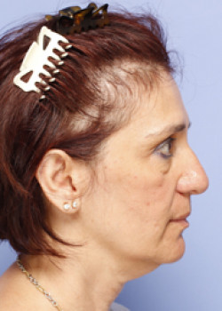 Facelift Patient – Case 9