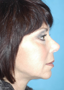 Facelift Patient – Case 11