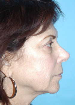 Facelift Patient – Case 11