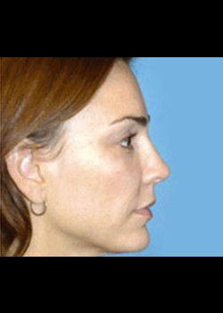 Facelift Patient – Case 12