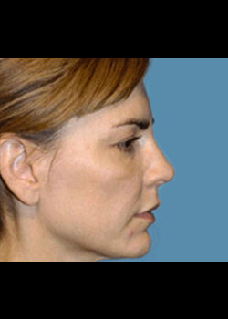 Facelift Patient – Case 12