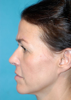 Facelift Patient – Case 13