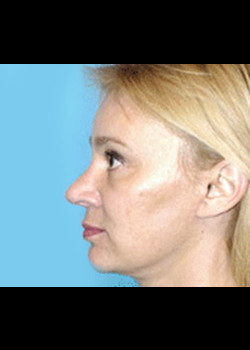 Facelift Patient – Case 15