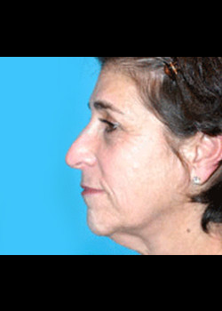 Facelift Patient – Case 16