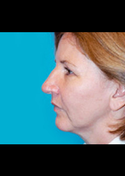 Facelift Patient – Case 17