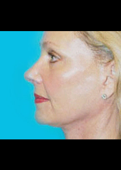 Facelift Patient – Case 19