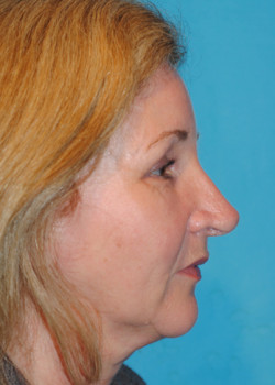 Eyebrow Lift – Patient 3