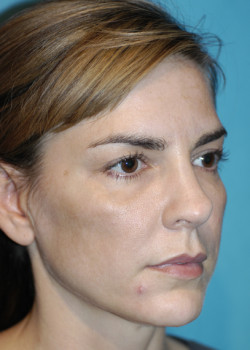 Eyebrow Lift – Patient 4