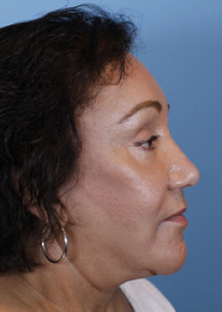 Eyebrow Lift – Patient 5