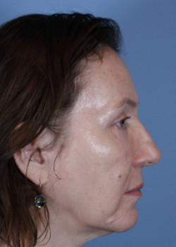 Eyebrow Lift – Patient 8