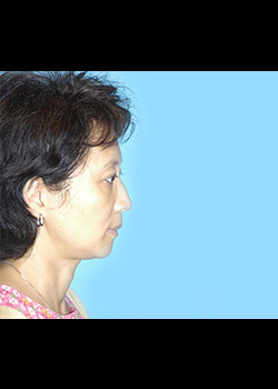 Blepharoplasty – Patient 1