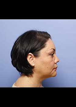 Blepharoplasty – Patient 2