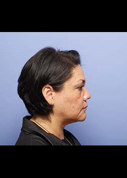 Blepharoplasty – Patient 2