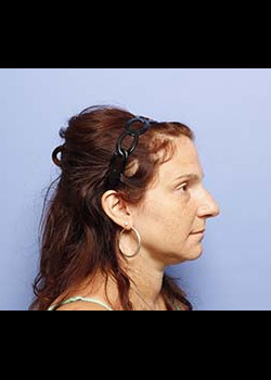 Blepharoplasty – Patient 4