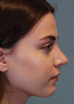 Rhinoplasty – Case 1