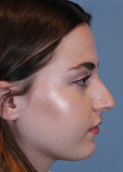 Rhinoplasty – Case 1