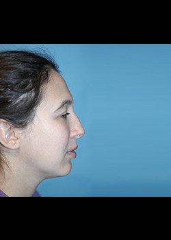 Rhinoplasty – Case 2