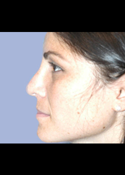 Rhinoplasty – Case 3