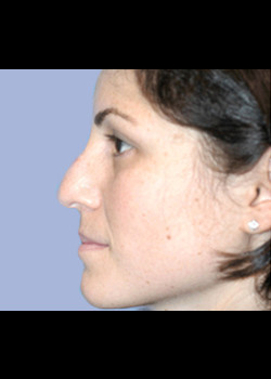 Rhinoplasty – Case 3