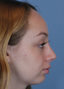 Rhinoplasty – Case 5