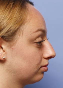 Rhinoplasty – Case 5